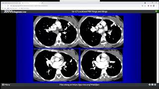 20 Localized Pulmonary Blood Flow Rings and Slings [upl. by Tallia]