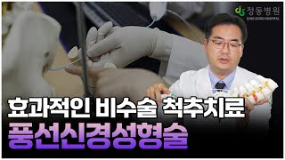 척추에 풍선을 넣어 치료하는 비수술 척추치료가 있다 허리디스크와 척추관협착증에 도움되는 풍선신경성형술 [upl. by Novar445]