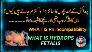 What is Hydrops Fetalis ماں کا بلڈ گروپ منفی ہو اور بچے کا مثبت ہو تو بچے پر کیا اثرات ہوتے ہیں۔ [upl. by Iarahs]