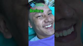 Sebaceous cyst  removal  dr bijay  tokha horizon [upl. by Stoffel760]