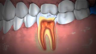 Treatment of Abscessed Teeth [upl. by Emorej]