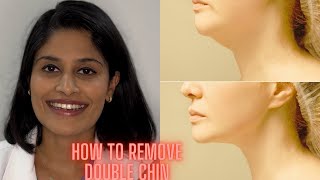 Double chin treatment in Hyderabad Telugu [upl. by Arratahs]