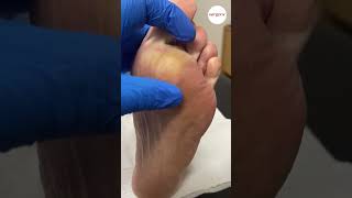 Ball of foot callus debridement with scalpel [upl. by Cornelia302]