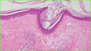 Lichen Sclerosus 🩺Treatment 🩺Symptoms 🩺Causes📰 [upl. by Enitsirhc501]