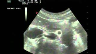 Renal ultrasound Right renal artery in B Mode [upl. by Yevad]