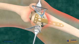 High Tibial Osteotomy HTO for Bow Leg Correction [upl. by Ordnas]