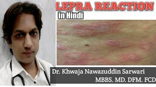 Lepra Reaction  In Hindi  Medicine  Microbiology  Skin  MBBS  ENL Leprosy Doctors Corner [upl. by Fernas692]