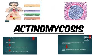 ACTINOMYCOSIS  IMAGES  MCQs [upl. by Kiryt124]