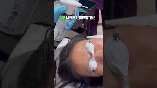 Effortlessly remove brown spots with Cryotherapy—quick minimal pain and effective results [upl. by Nutter]