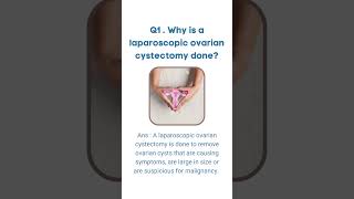 Faqs About Laparoscopic Ovarian Cystectomy  OM Hospital Birgunj [upl. by Odo]