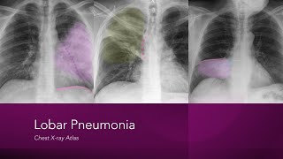 Lobar Pneumonia Chest Xray Atlas [upl. by Etem]