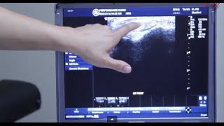 Musculoskeletal Ultrasound Peroneal  MSK Ultrasound Ankle [upl. by Ibson]