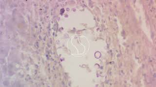 Cryptococcus neoformans under the microscope with Periodic acidSchiff PAS stain [upl. by Wilmar]