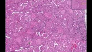 Histopathology KidneyDiabetic glomerulosclerosis [upl. by Cammi]