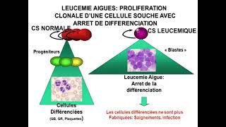 Hemato 12Hémopathies malignes et leucémies aigues Dr Abbadi [upl. by Shyamal238]