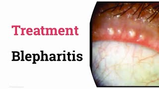 Treatment of Blepharitis [upl. by Ramona]