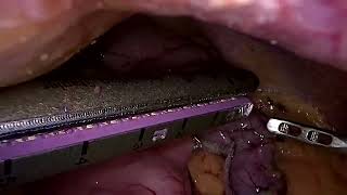 Laparoscopic Sleeve Gastrectomy 24 Asma [upl. by Derick205]