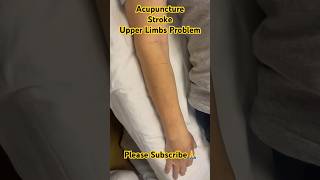 Acupuncture  Stroke  Upper Limbs Problem viral tcm acupuncture dr shorts shortsfeed [upl. by Ferino]