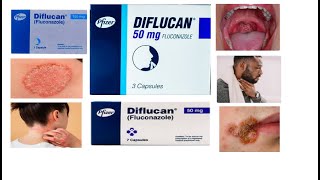 Diflucan tablet  Uses  Side effects  HindiUrdu [upl. by Isnyl]