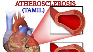 Atherosclerosis in tamil class medics [upl. by Daphie257]