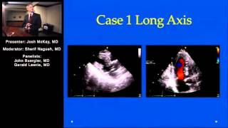 Alcohol Septal Ablation for Hypertrophic Obstructive Cardiomyopathy Panel Discussion [upl. by Amberly]