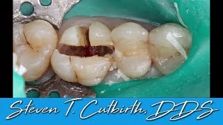 Sectioning and Extraction of Maxilary First Molar  with Steven T Cutbirth DDS [upl. by Cristabel]