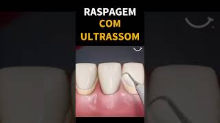 RASPAGEM E ALISAMENTO RADICULAR COM ULTRASSOM dentist odonto shorts raspagem calculodental [upl. by Atiekan]