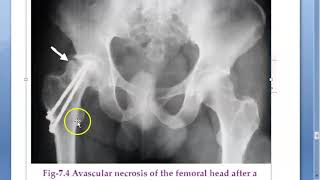 Orthopedics 063 Local Complications of Fracture Part 3 Late Avascular necrosis Sudeck dystrophy [upl. by Nugent]