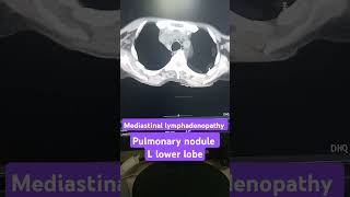 Mediastinal lymphadenopathy on CT scan pulmonary nodule on CT scan [upl. by Agem]