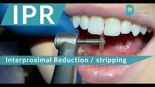 IPR 🪚🦷 Interproximal Reduction  stripping [upl. by Macnair864]