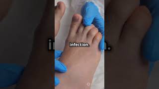 Understanding Diabetic Foot Problems [upl. by Lainad384]