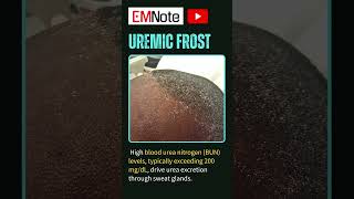 Uremic Frost of ESRD nursing doctor medical [upl. by Ttenneb]