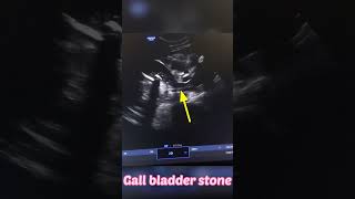 Gb stone cholelithiasis shorts short shortvideo viralvideo videoshort doctor radiologist [upl. by Barrington289]