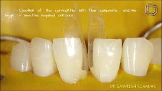 Lower Diastema Closure [upl. by Yrad]