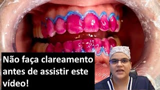 Não faça clareamento antes de assistir este vídeo Master Pride Odontologia  Dra Bianca Rosa [upl. by Scheer]