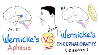 Wernicke’s Aphasia vs Wernickes Encephalopathy  Neurology [upl. by Standice]