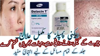 Best Acne Lotion  Dalacin T Lotion  Calindamycin 1 Acne Lotion Review In Urdu Hindi [upl. by Lubow399]