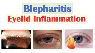 Blepharitis Eyelid Inflammation  Causes Risk Factors Signs amp Symptoms Diagnosis Treatment [upl. by Jeroma]