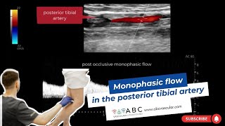 Monophasic flow in the posterior tibial artery  Ultrasound [upl. by Etsyrk]