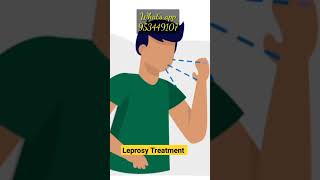 कुष्ठ रोग सुनबहरी Leprosy causes symptoms and homoeopathic treatment drkailashprasad [upl. by Araas]