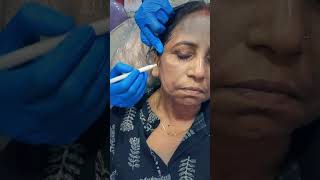 Full Face Botox Treatment  Thread Filler  Botox  Kolkata  youtubereels youtubeshorts reels [upl. by Kurtz]