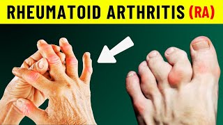 Rheumatoid Arthritis Symptoms You Need to See a Doctor ASAP [upl. by Regan]