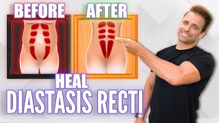 5 Advanced Diastasis Recti Exercises  Postpartum Deep Core Workout [upl. by Leund]