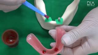 Dental Implant education video overdenture part [upl. by Loats]