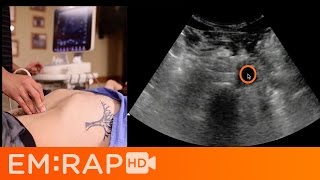 Ultrasound of Abdominal Aortic Aneurysm AAA [upl. by Naimerej]