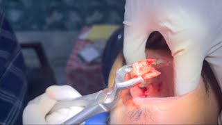 Maxillary Second Molar Extraction  upper second molar extraction youtube dentistry trending [upl. by Enoryt]