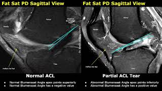 MRI Knee Normal Vs ACL Tear  Anterior Cruciate Ligament Tears  Sports Injuries Imaging Cases [upl. by Cherry]