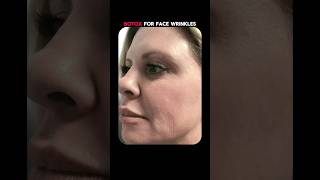 Botox for face wrinkles by Dr Haritma Gupta  BBA Podcast  Anoop Kumar [upl. by Audly774]