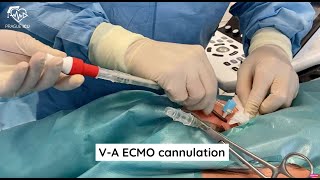 ECMO cannulation [upl. by Jillayne]