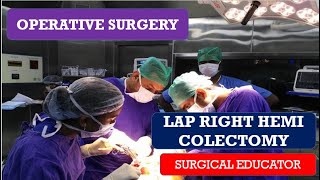 LAP RIGHT HEMICOLECTOMY STEP BY STEP OPERATIVE SURGERY [upl. by Kira]